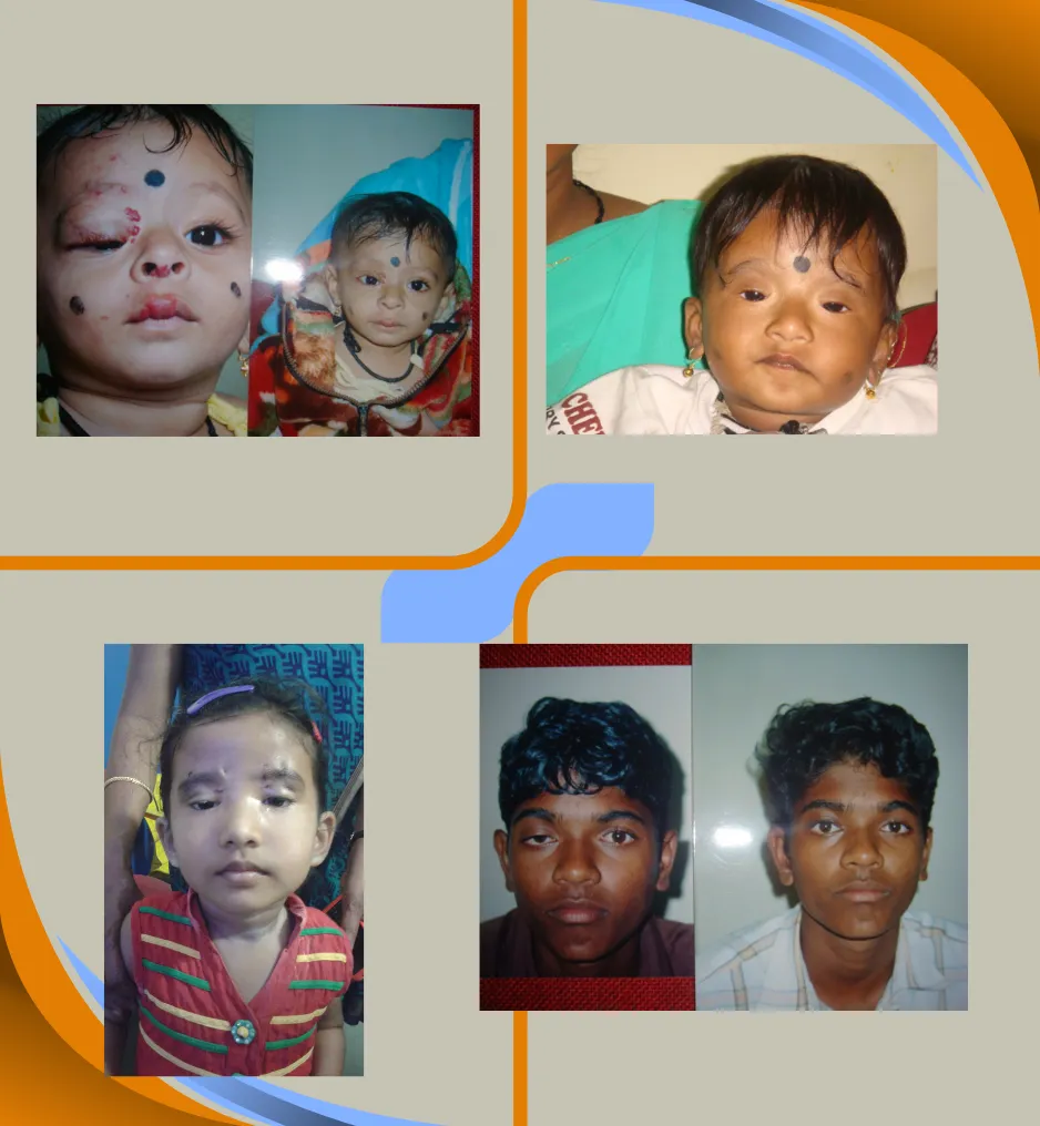 Oculoplasty
